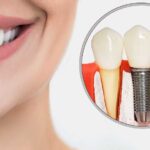 Dental Implants: Cost, Procedure & Benefits - Nectar Health