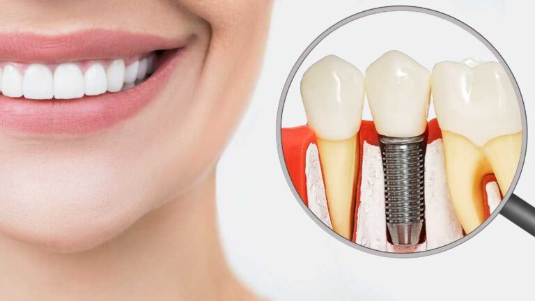 Dental Implants: Cost, Procedure & Benefits - Nectar Health