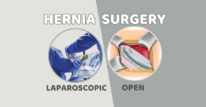 Types of Hernia Surgery- Nectar Health