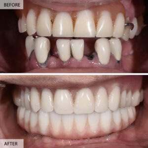 Before and After All on 4 Dental Implants