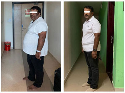 bariatric-surgery-before-after-nectar-health