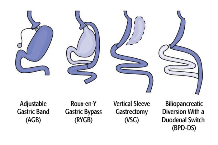 bariatric-surgery-types-nectar-health