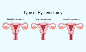 types-of-hysterectomy-nectar-health